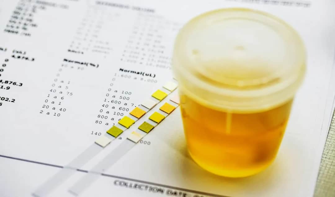 Ile moczu do badania: sprawdzona instrukcja prawidłowego pobrania próbki