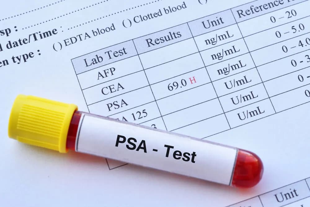 PSA - Co to za badanie i dlaczego jest kluczowe dla zdrowia prostaty
