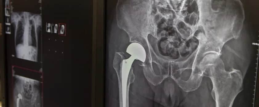 Wszystkie endoprotezy stawu biodrowego refundowane przez NFZ w 2025 roku