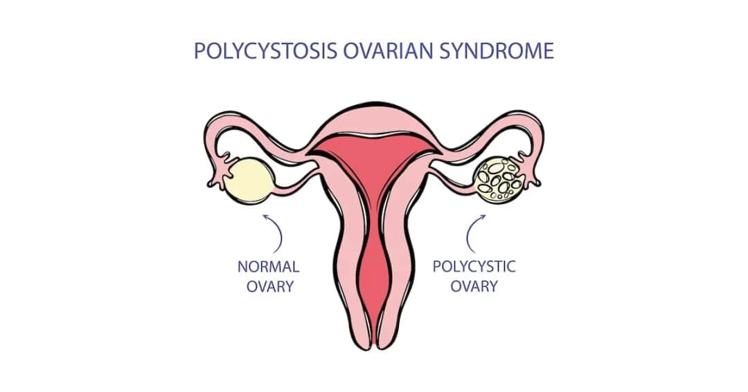 PCOS: jakie badania krwi są kluczowe dla diagnozy i zdrowia jajników?