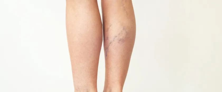 Do jakiego lekarza zgłosić się z zakrzepicą: kompletna lista specjalistów