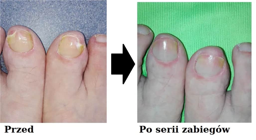 Grzybica paznokci - który lekarz najskuteczniej wyleczy tę chorobę?