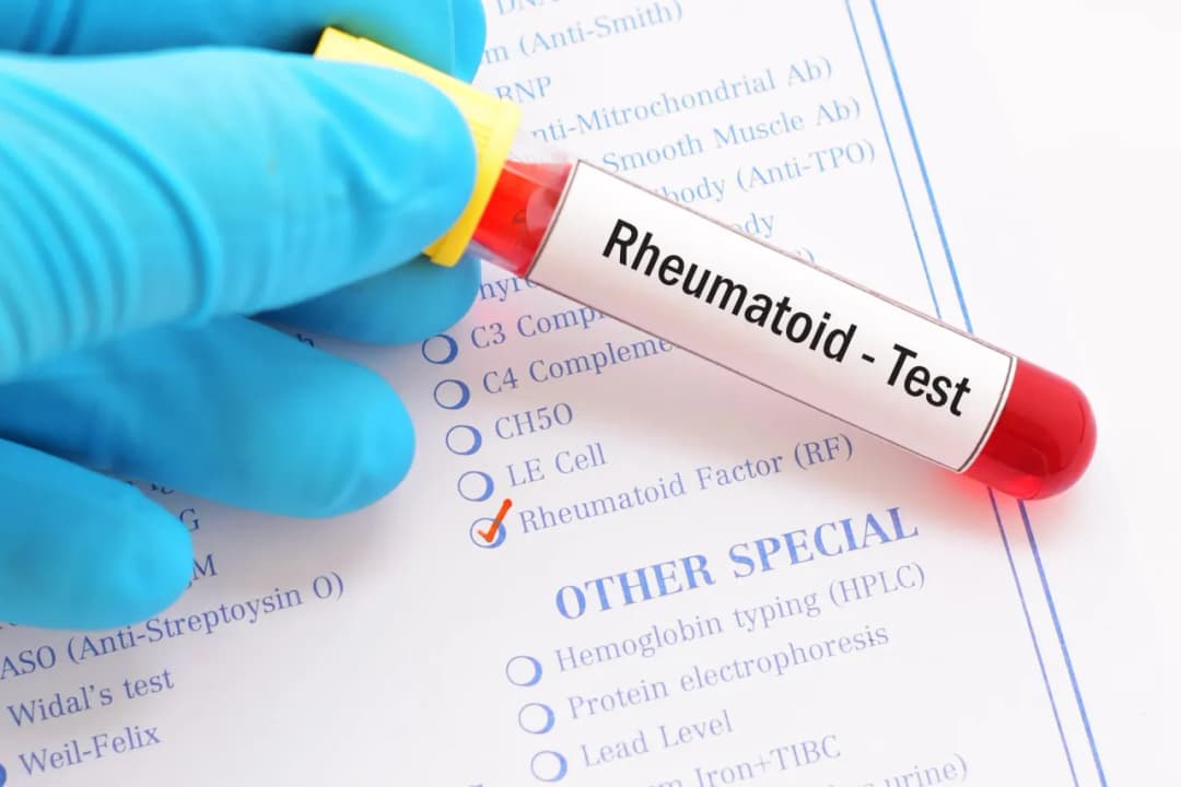 Badanie RF co to jest i jakie ma znaczenie w diagnostyce chorób autoimmunologicznych