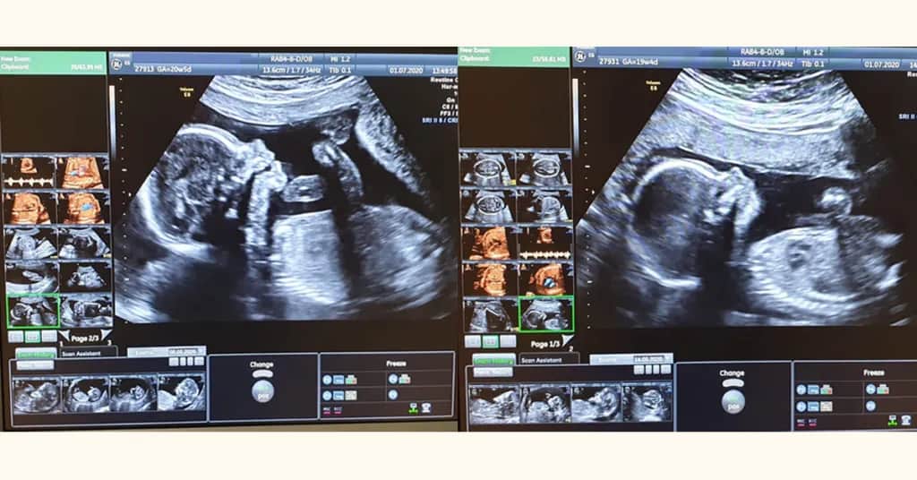 Badania prenatalne - sprawdź terminy wykonania każdego badania w ciąży