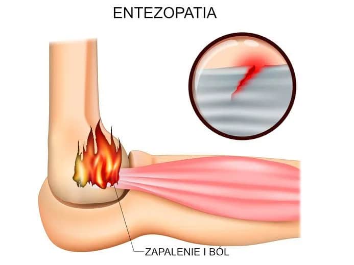 Który lekarz specjalista zajmuje się leczeniem entezopatii: poradnik pacjenta