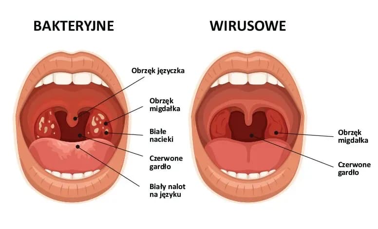 Czy angina jest zakaźna? Poznaj okres zarażania i skuteczną profilaktykę