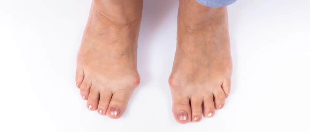 Haluks przyczyny: Dlaczego powstają i jak ich unikać?