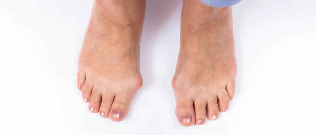 Haluks przyczyny: Dlaczego powstają i jak ich unikać?