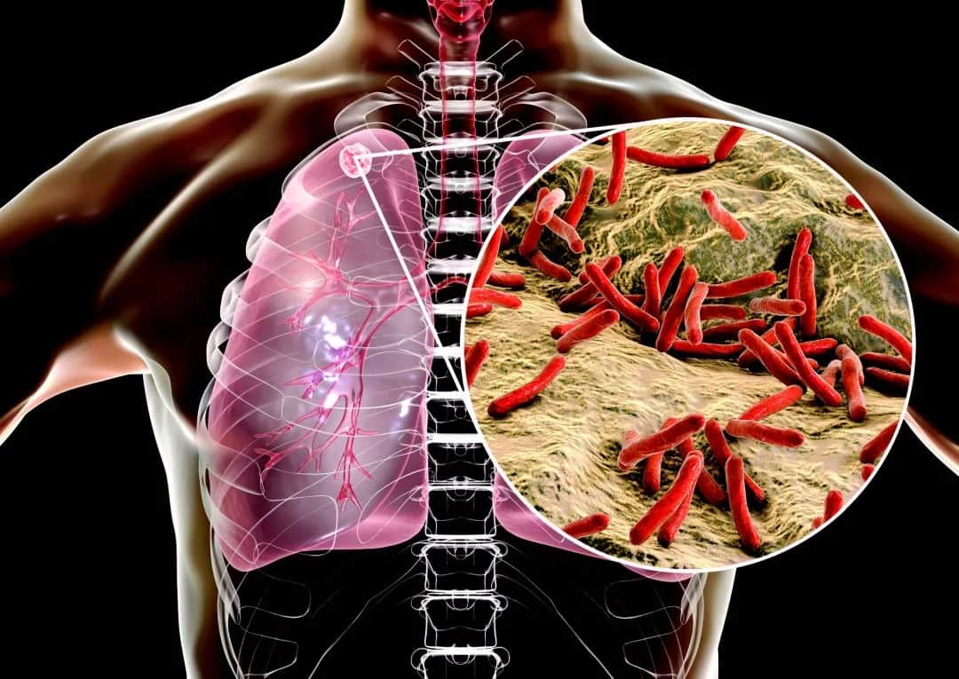 Gruźlica - co warto wiedzieć o tej chorobie?