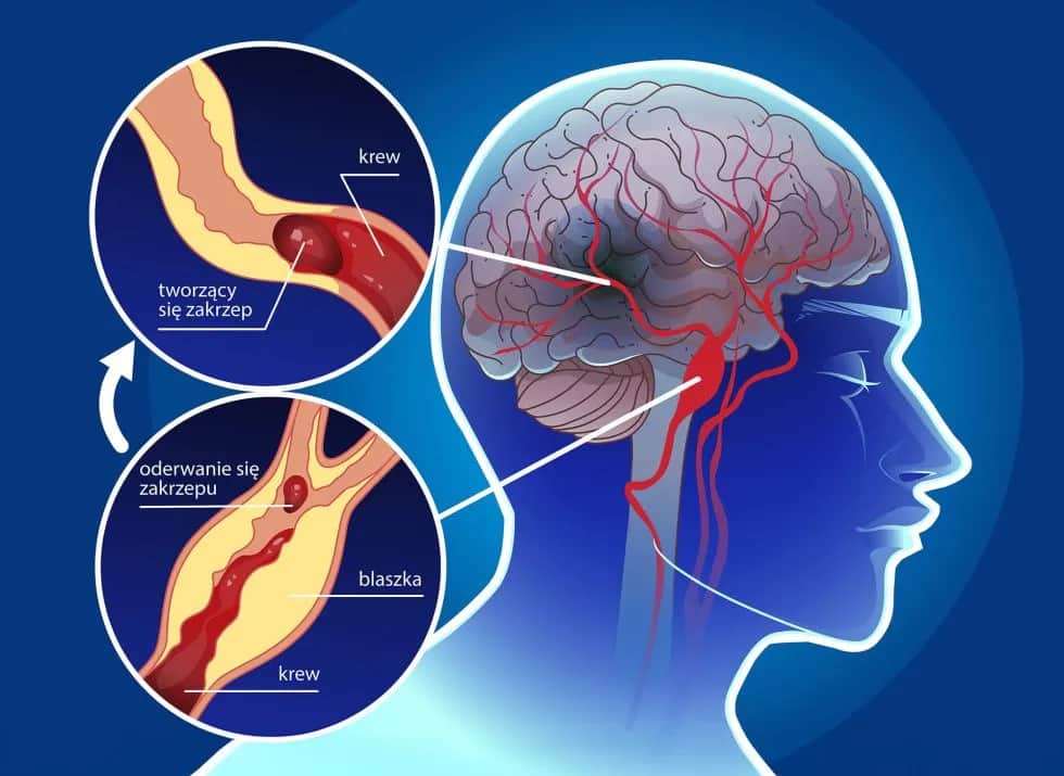 Udar mózgu – przyczyny, objawy i skutki, których nie możesz ignorować