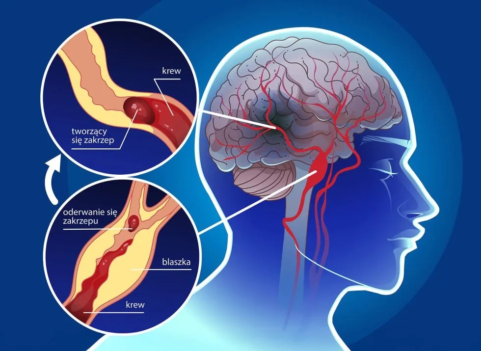 Udar mózgu – przyczyny, objawy i skutki, których nie możesz ignorować
