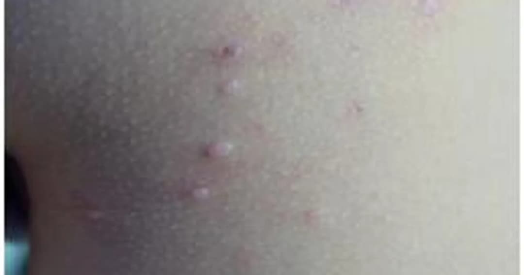 Skuteczne sposoby na mięczaka zakaźnego - 7 najlepszych metod leczenia