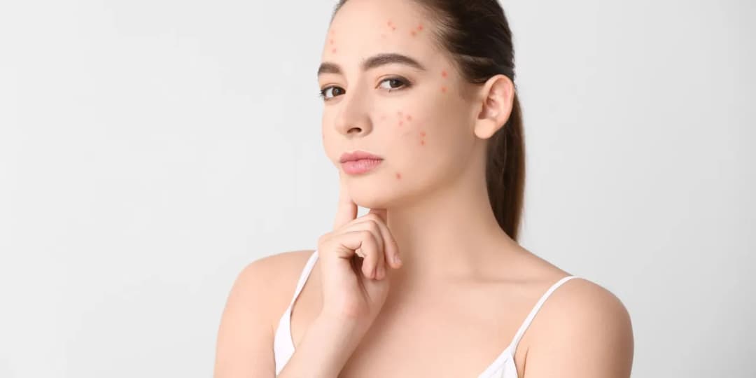 Czy emolienty mogą uczulać? Sprawdź, co musisz wiedzieć o alergiach