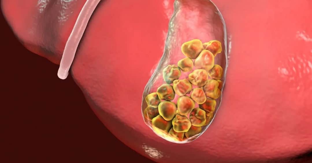 Czy można pić alkohol przy kamicy żółciowej? Ważne informacje i ryzyka