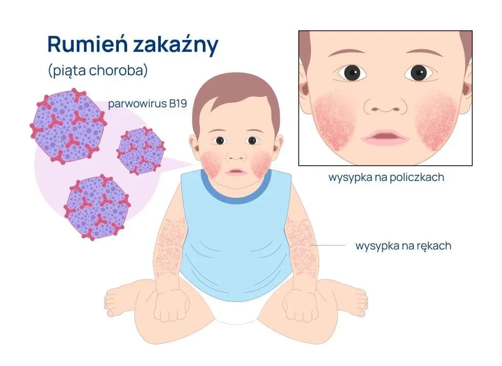 Rumień zakaźny - poznaj wszystkie drogi zakażenia i skuteczną profilaktykę