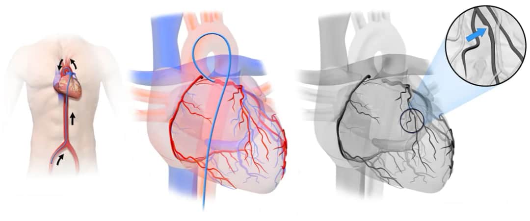 Koronarografia – Kluczowe Badanie Diagnostyczne Stanu Twojego Serca