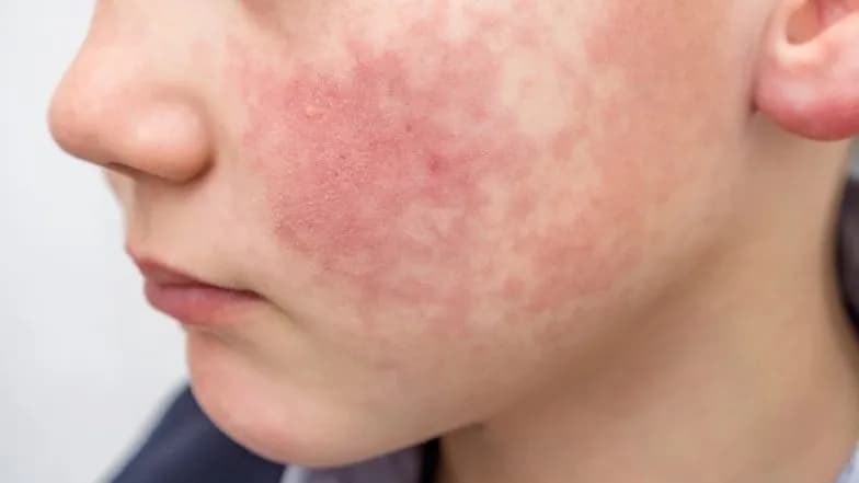 Kiedy rumień zakaźny naprawdę zaraża? Kluczowe fakty o zakaźności