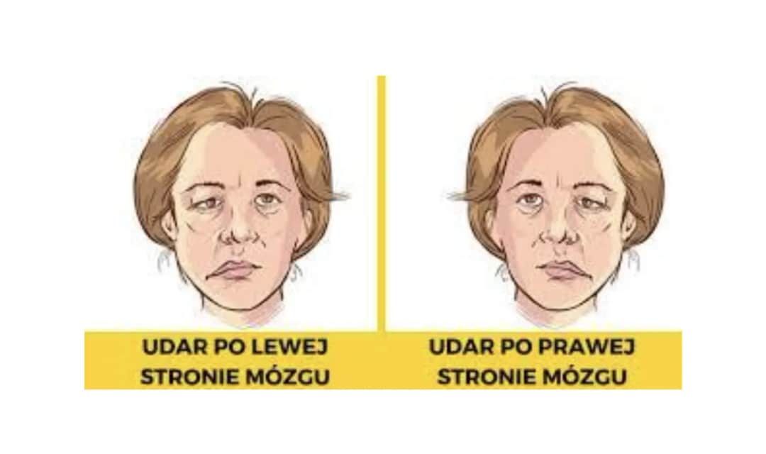 Który udar jest groźniejszy: prawostronny czy lewostronny? Porównanie skutków i rokowania